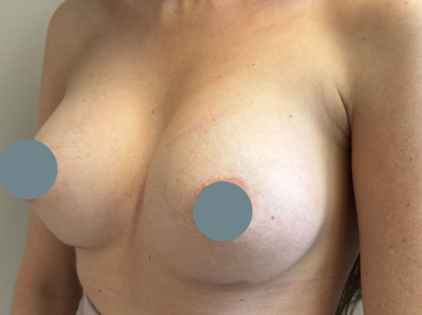 SSJ Breast Augmentation After