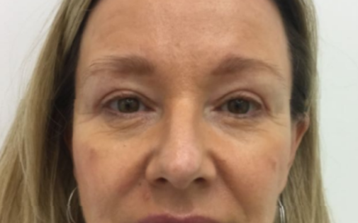 Unknown After Upper Blepharoplasty