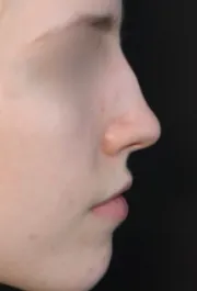 TJ Before Rhinoplasty