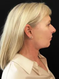 KY After Face and Neck Lift with Fat Transfer