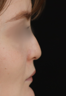 TJ Before Rhinoplasty
