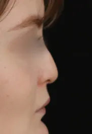 TJ Before Rhinoplasty