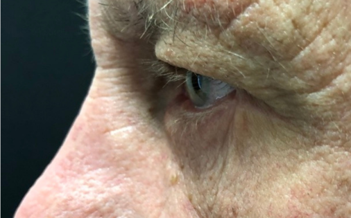 GG After Male Lower Blepharoplasty