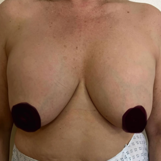 Breast Lift GG Before