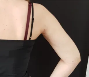 HS Arm Lipo 2 After Back