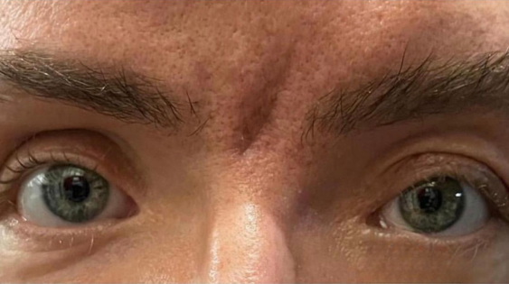 EH After Male Upper Blepharoplasty