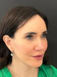 KY After Deep Plane Face and Neck Lift, Brow Lift, Lip Lift, Bleph & Fat Transfer