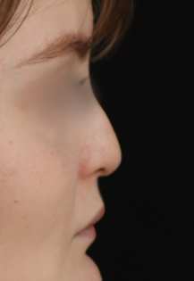 TJ Before Septorhinoplasty