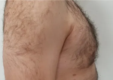 HS Male Chest Liposuction After 1 Side