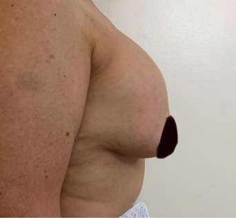 GG Before Mastopexy Side