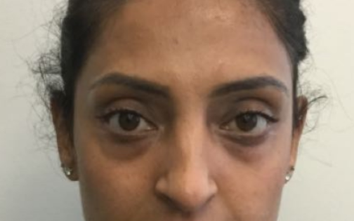 EH Before Lower Blepharoplasty
