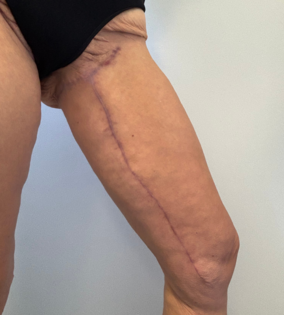 SSJ Thigh Lift After