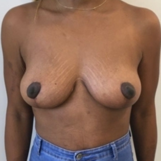 Breast Lift Unknown After