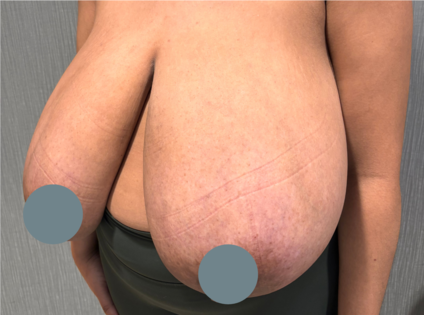 SSJ Breast Reduction Before