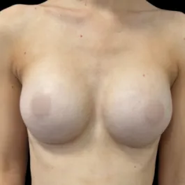 MK Breast Augmentation After