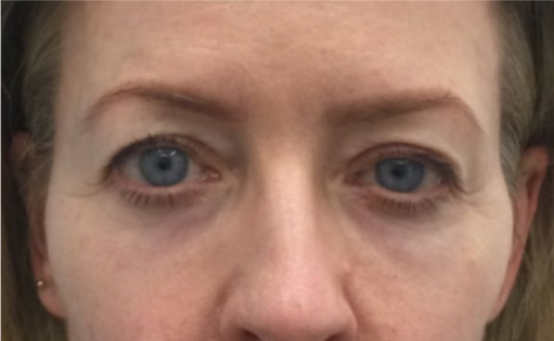 EH Before Upper Blepharoplasty