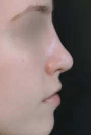 TJ After Rhinoplasty