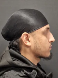 AN Rhinoplasty Before