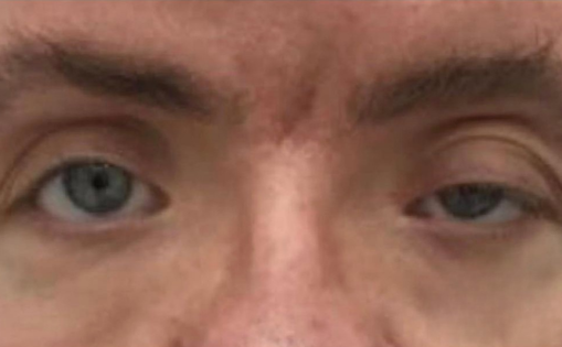 EH Before Upper Blepharoplasty