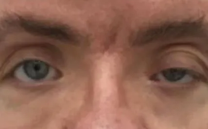 EH Before Upper Blepharoplasty