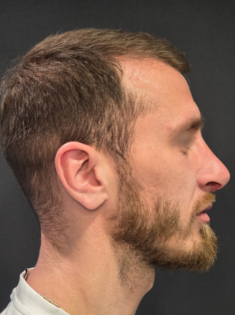 AN Rhinoplasty After