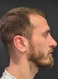 AN Rhinoplasty After