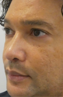 PT After Nose Tip Rhinoplasty