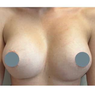 Cadogan Clinic SSJ Breast Augmentation After