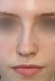 TJ Before Septorhinoplasty Front