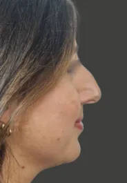 AN Septorhinoplasty Before Side