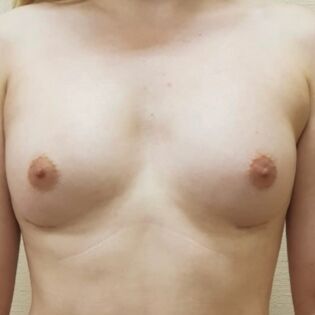 Cadogan Clinic DDV FT Breast After