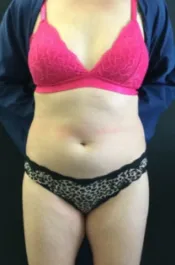 HS Abdomen Lipo Before 1 Front