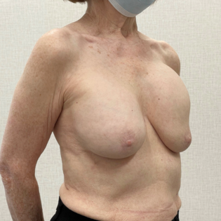 Cadogan Clinic Breast Implant Revision