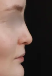 TJ After Septorhinoplasty Profile