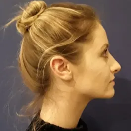 Unknown After Rhinoplasty