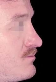 MA Male Rhinoplasty After Side