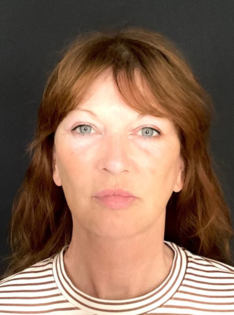 KY After Deep Plane Face and Neck Lift, Brow Lift, Lip Lift, Bleph & Fat Transfer