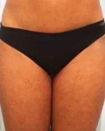 Unknown Inner Thigh Liposuction Before 1 Front