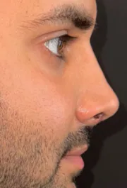 SP After Septorhinoplasty