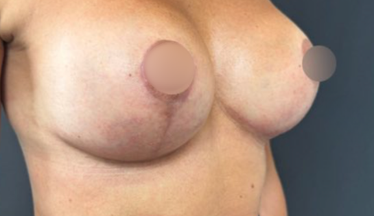 WVN After Mastopexy & Implant Exchange Three Quarters