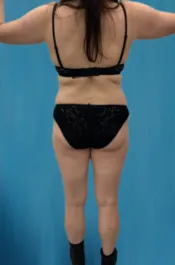 OT Flanks Liposuction After 1 Back