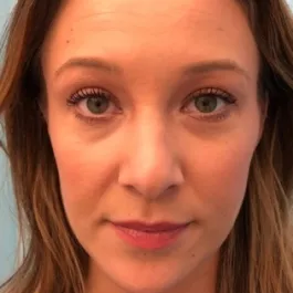 Unknown After Rhinoplasty