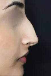 TJ Before Rhinoplasty
