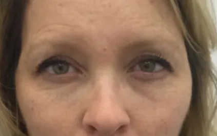 Unknown Before Upper Blepharoplasty Front