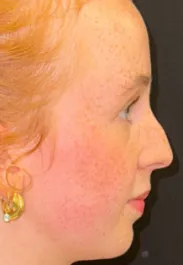 SP Rhinoplasty Before Side
