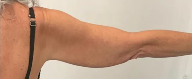 Cadogan Clinic PT Arm Lift Before