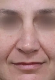 TJ After Septorhinoplasty Front
