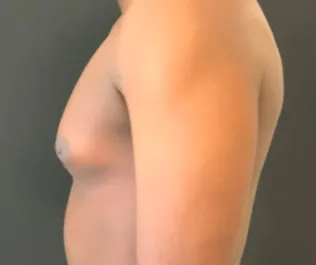 OT Male Chest Liposuction Before 1 Side