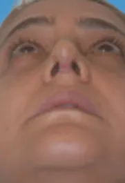 SP Septoplasty After pt.3