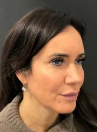 KY Before Deep Plane Face and Neck Lift, Brow Lift, Lip Lift, Bleph & Fat Transfer